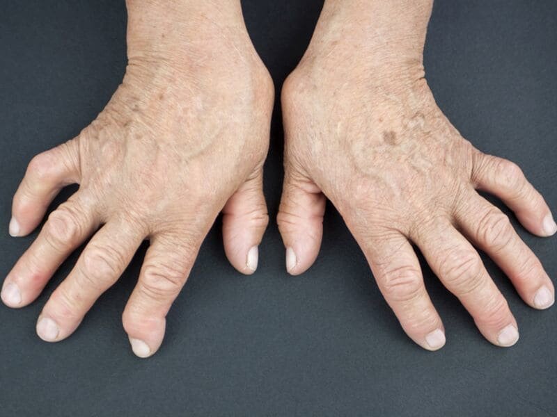 artritis i njegovi tretmani
