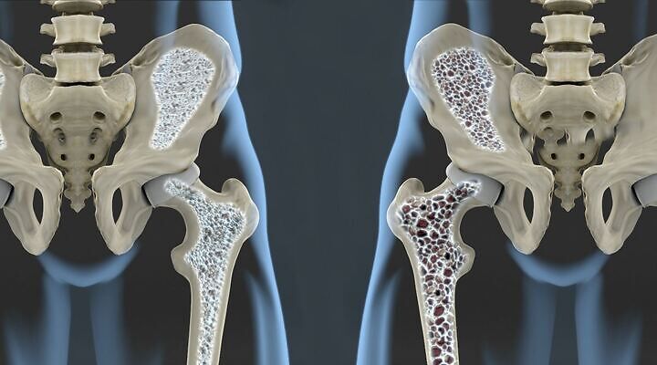 Osteoporoza simptomi