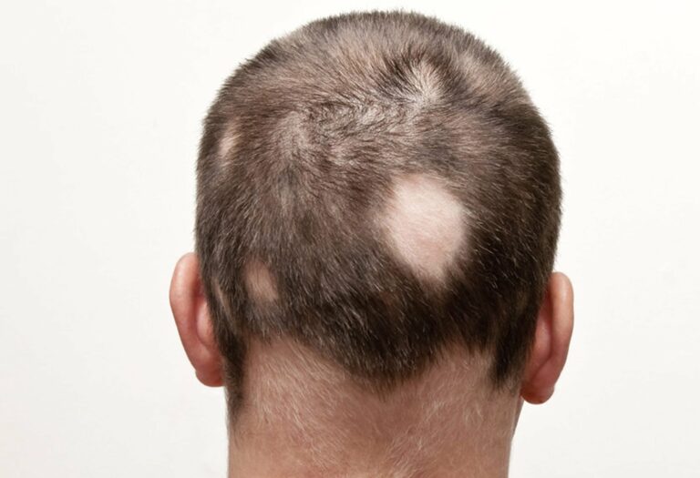 Alopecija areata