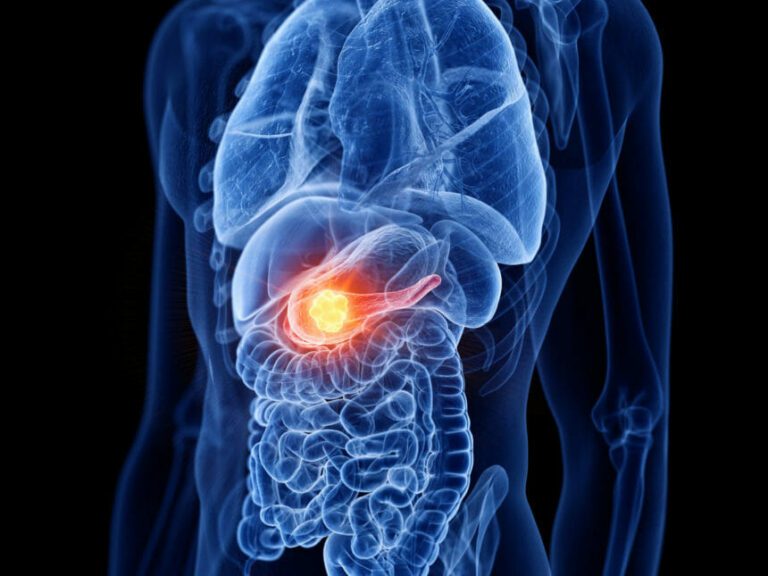 Rak pankreasa simptomi