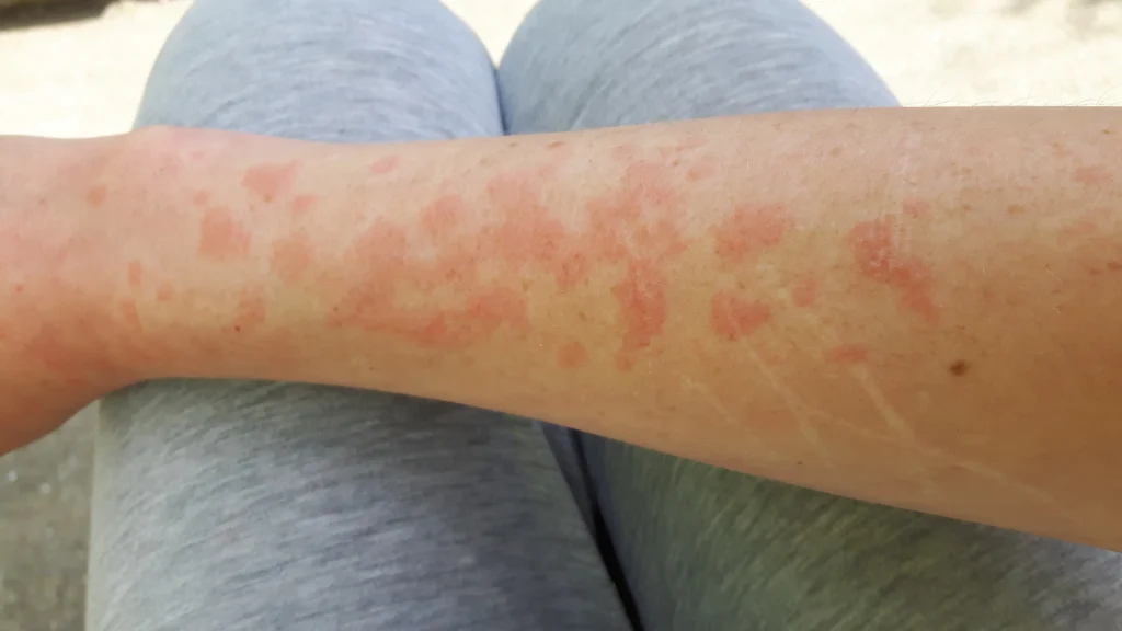 Alergija na sunce 
