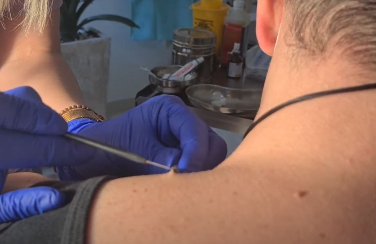 Dermatolog uklanja viseću bradavicu krioterapijom tečnim azotom, tretman je brz, bezbolan i bez ožiljaka.