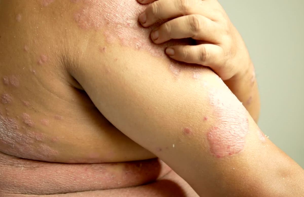 Psorijaza ko telu, na stomaku i rukama.