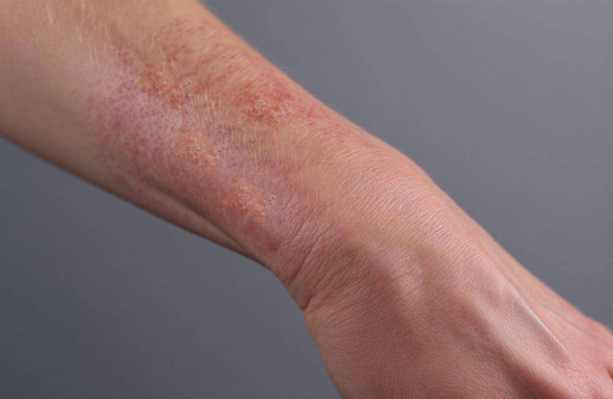 Psorijaza nastaje usled prekomerne aktivnosti imunog sistema, što ubrzava obnavljanje ćelija kože.