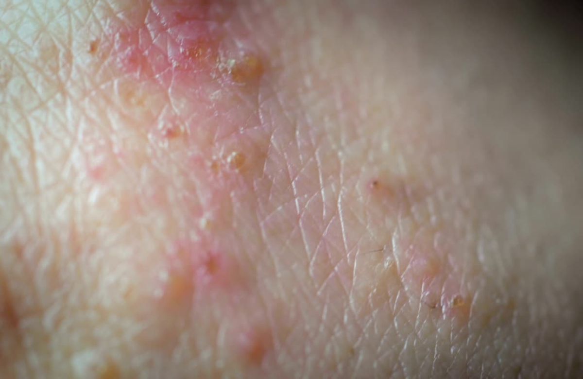 Zumirana slika psorijaze na koži