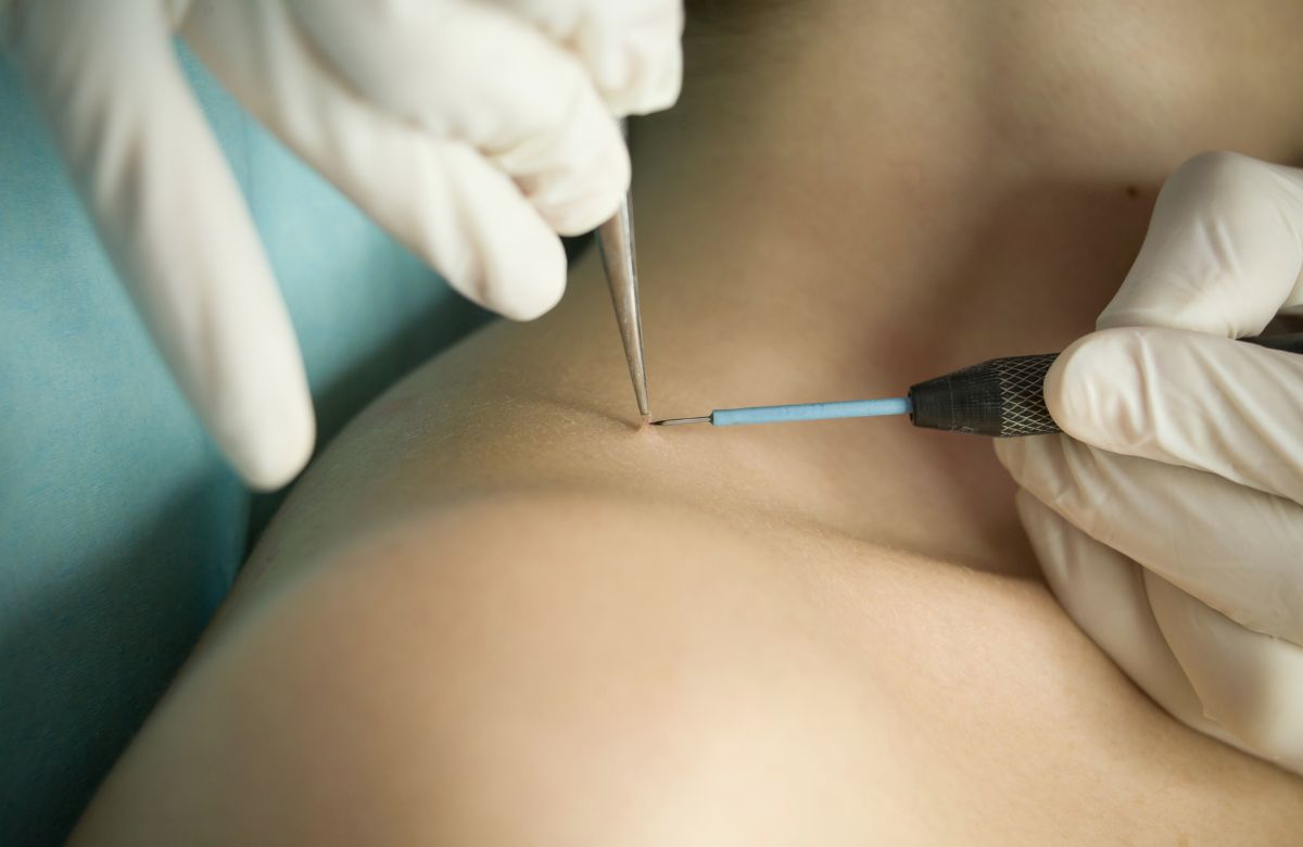 Virusne bradavice nastaju HPV-om, lako se šire dodirom, češće kod dece, zahtevaju pažljivu higijenu i ponekad lečenje.