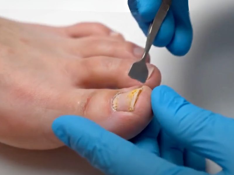 Osoba sa gljivicama na noktima kod dermatologa