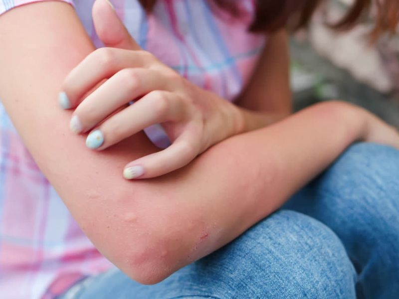 prikaz devojke kojoj je na ruci iskočio ospi zbog alergijske reakcije