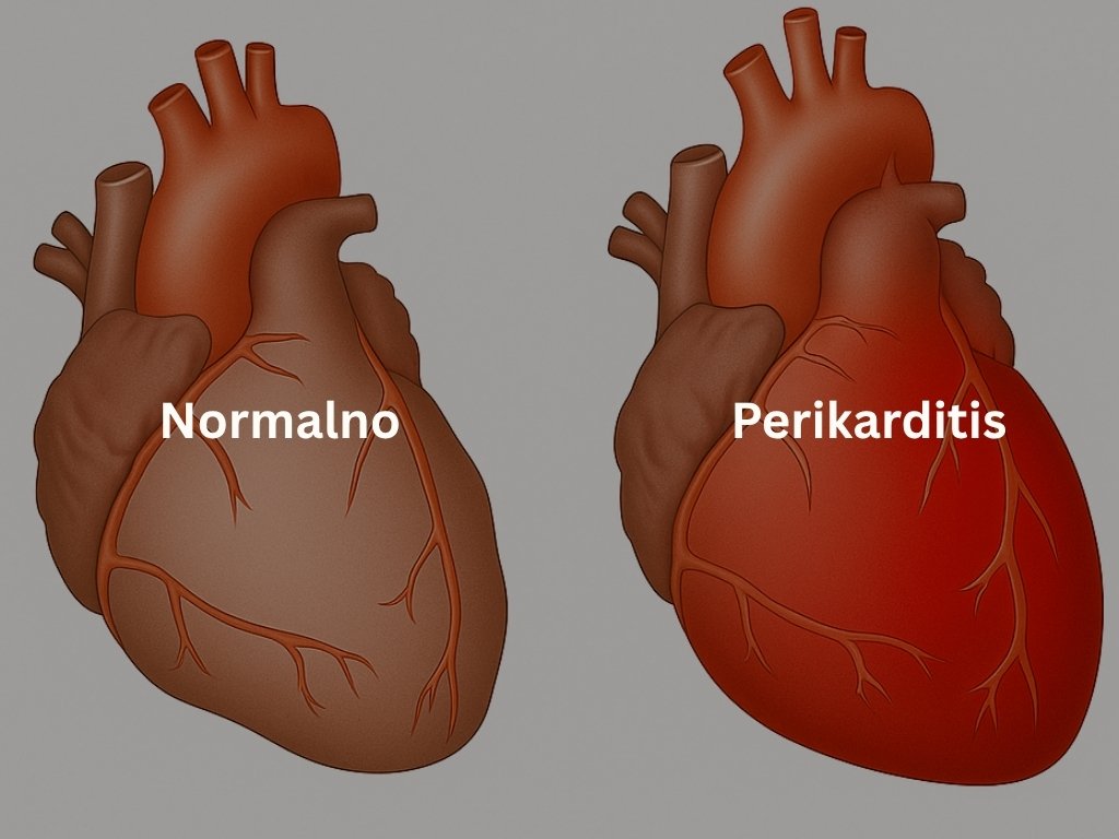 Prikaz normalnog srca i srca sa perikarditisom
