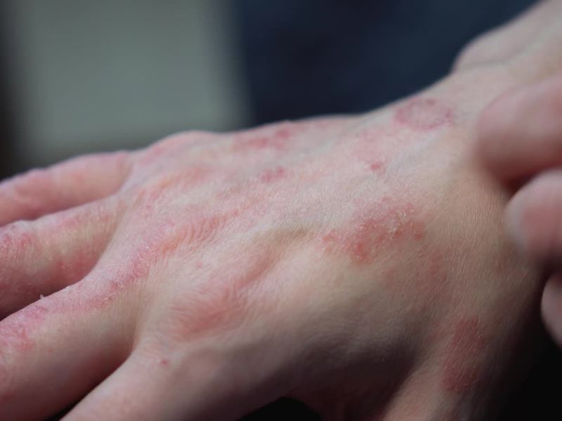 prikaz jakog osipa na šakama