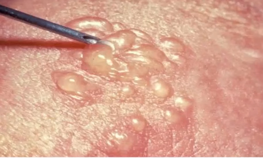 Osip se javlja u vidu bolnih mehurića grupisanih u pojasu, najčešće na jednoj strani tela ili lica.