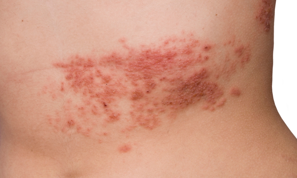 herpes zoster