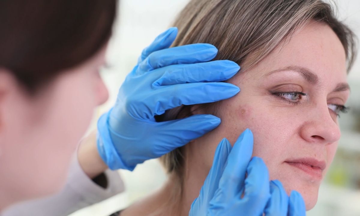 ženska osoba na pregledu keratoze kod dermatologa