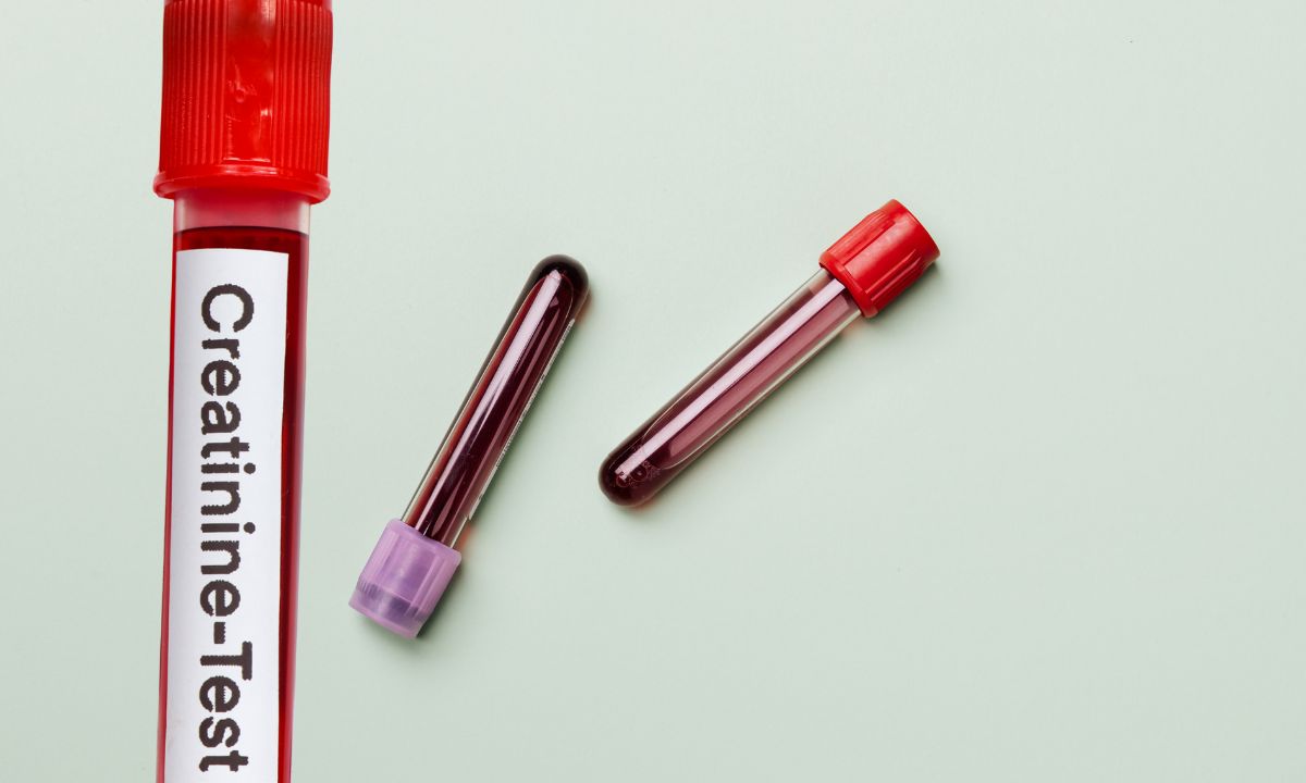 prikaz kreatinin testa