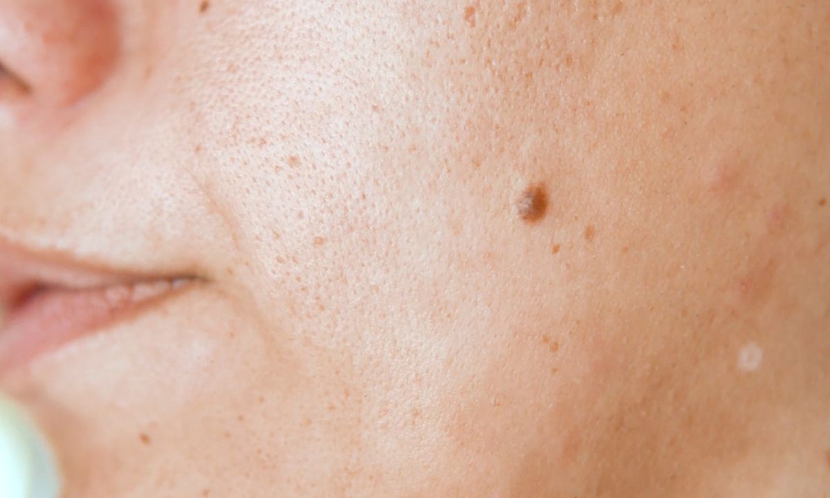 prikaz keratoze na licu kod starije žene