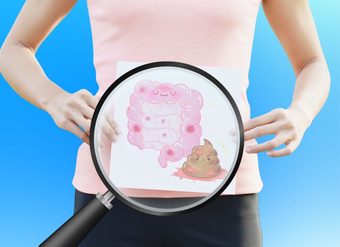 lupom prikazan stomak na kom se vidi krv u stolici u stomaku