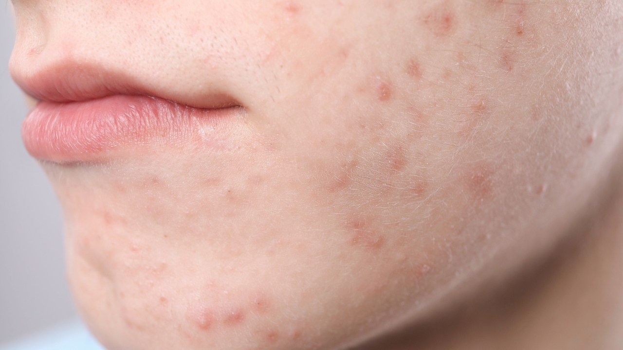 Krupan plan donjeg dela lica sa vidljivim aknama duž vilice i brade, tipičnim za hormonski disbalans