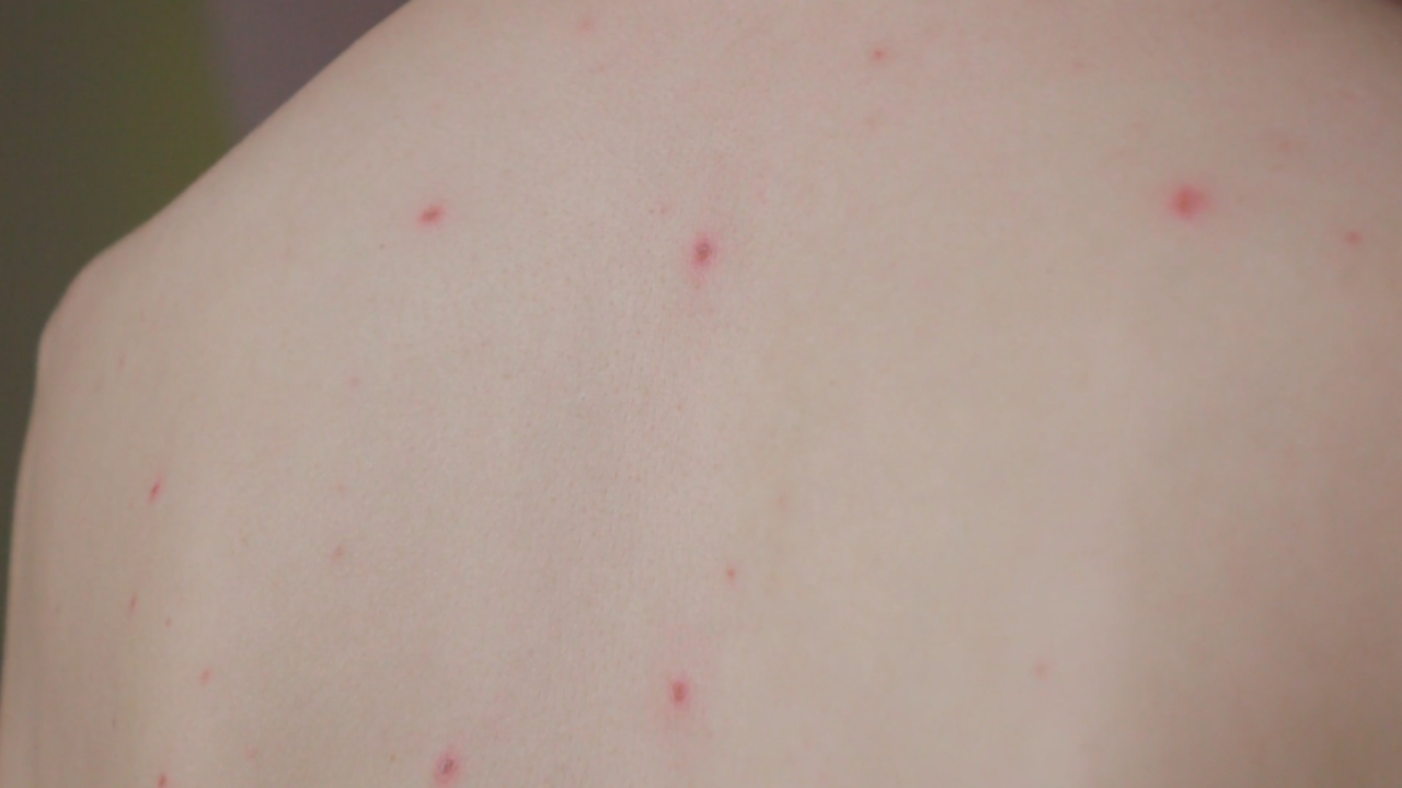 Osip kod velikih boginja sa sitnim crvenim promenama rasutim po koži leđa