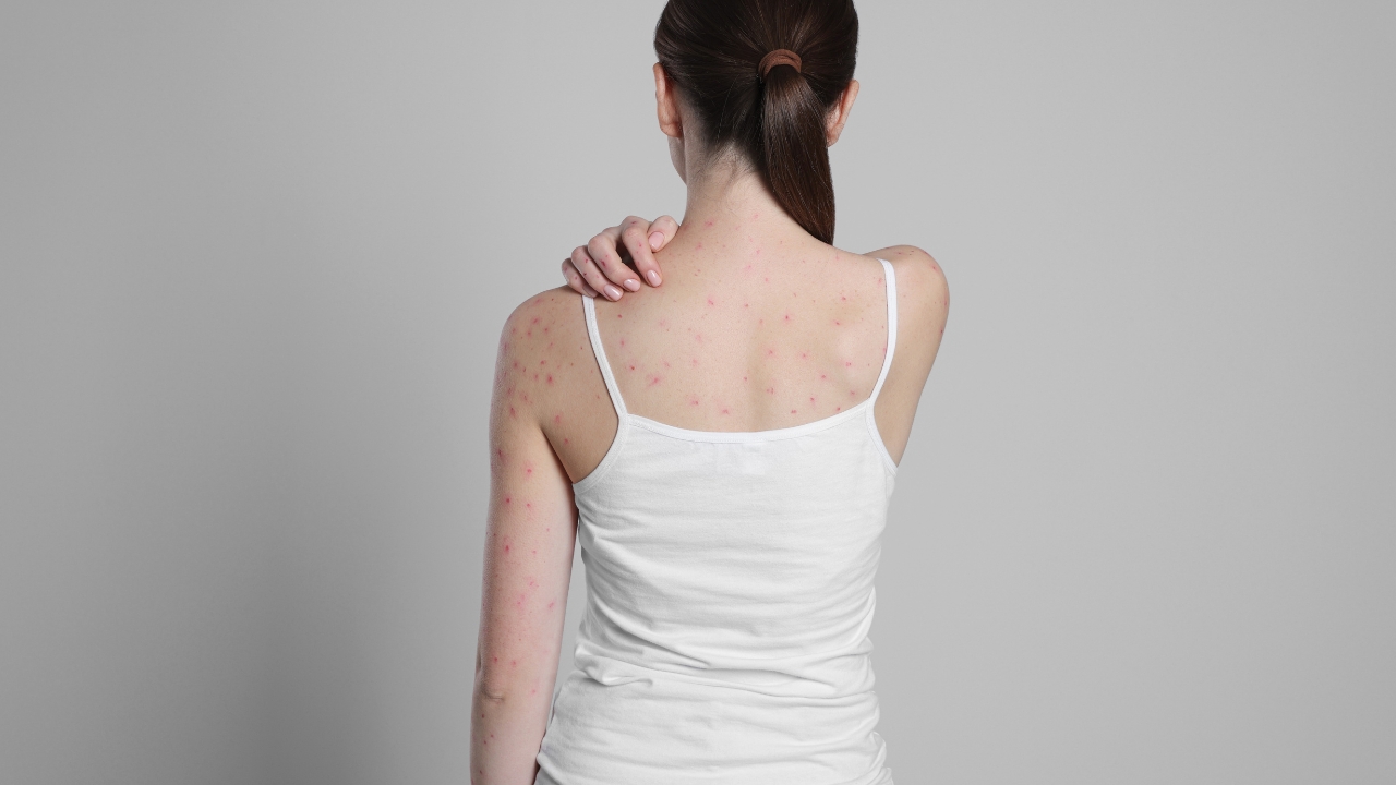 Osip kod velikih boginja vidljiv na leđima žene sa brojnim crvenim promenama po koži