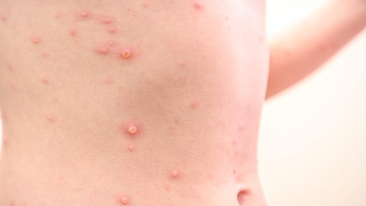 Velike boginje prikazane kroz osip sa izraženim crvenim plikovima na koži stomaka