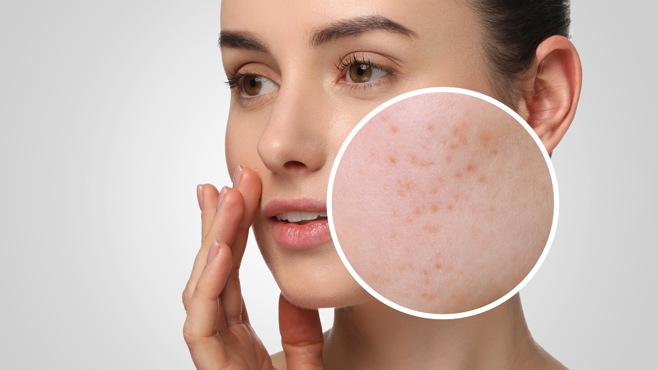 Žena dodiruje lice dok je u krupnom planu prikazana koža sa flekama, što jasno pokazuje uticaj hormona na kožu
