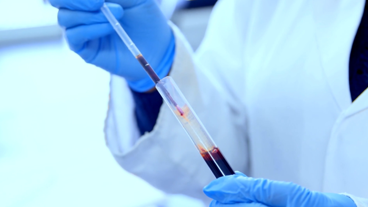 Laboratorijski radnik pipetom uzima uzorak krvi za PCT analizu