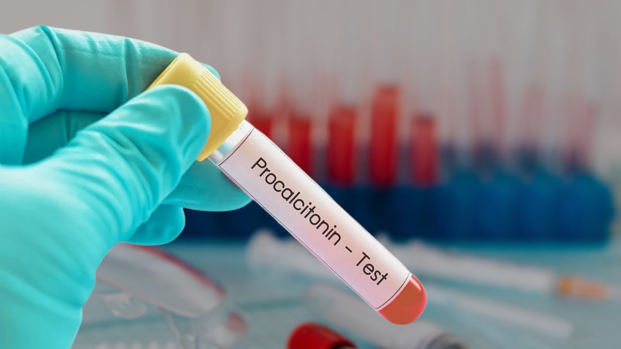 Ruka u rukavici drži epruvetu za test prokalcitonina