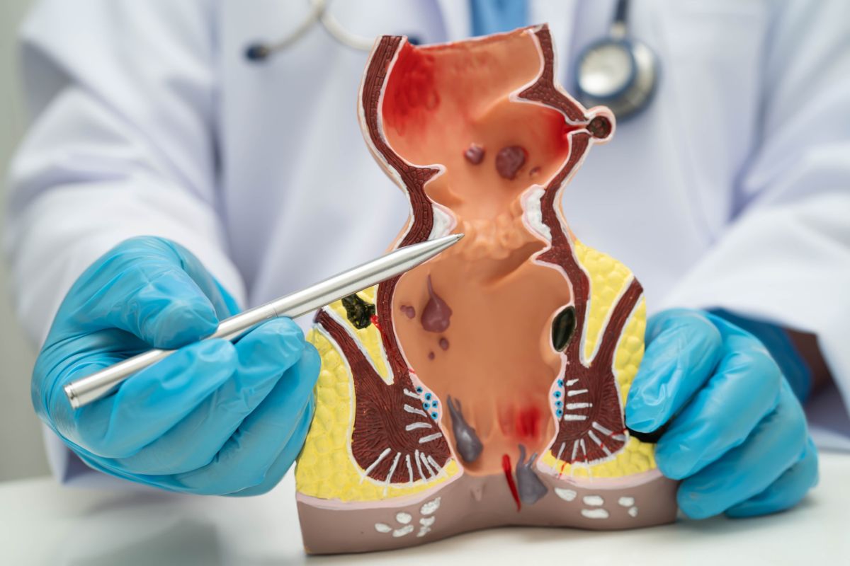 Lekar u rukavicama pokazuje anatomski model završnog dela debelog creva i analne regije sa prikazom hemoroida